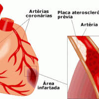 Síntomas de infarto de miocardio