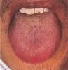 Diagnóstico por la lengua roja MTC
